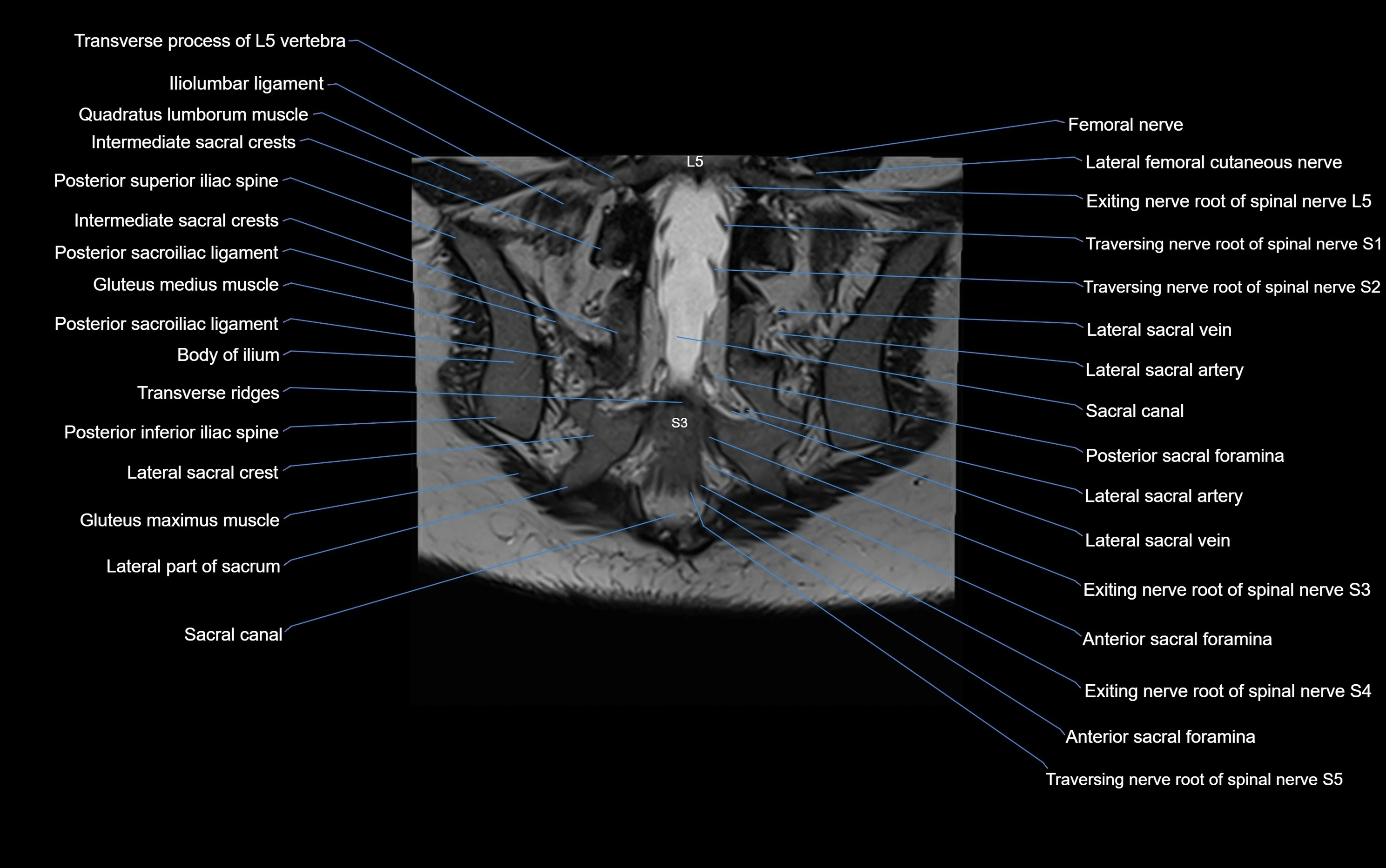 MRI sacroiliac joint coronal cross sectional anatomy  radiology  image-img-00001-00024.webp